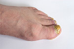 Fungal-toenail-infection