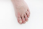 Is-it-really-a-fungal-toenail-infection